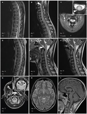 Fulminant Acute Ascending Hemorrhagic Myelitis Treated with Eculizumab